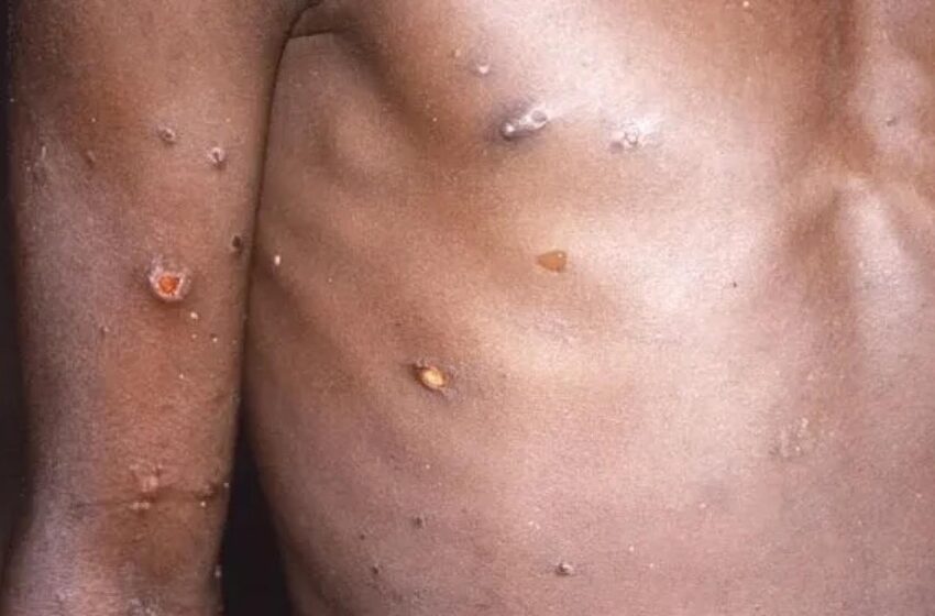  Santé : Un cas de variole du singe détecté à Dakar